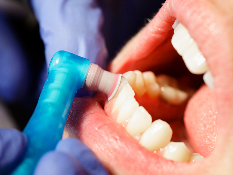 Teeth Whitening – Everything You Need to Know